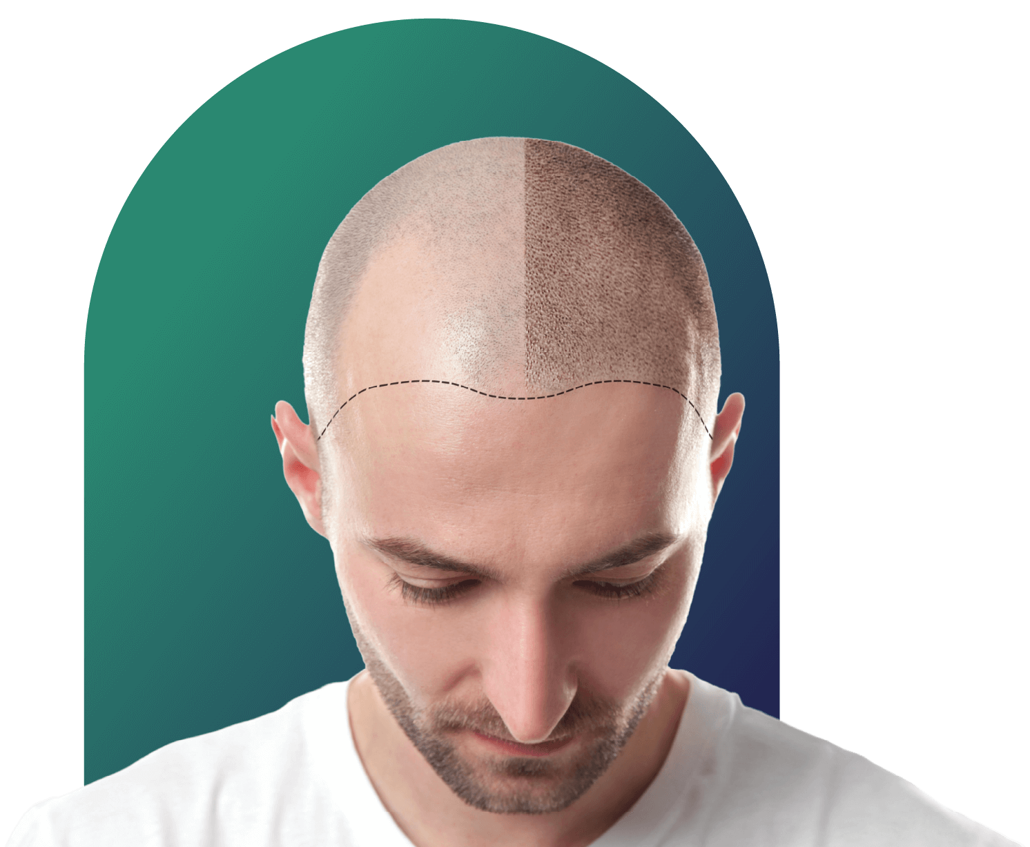 best hair transplant center in Kochi & Kozhikode