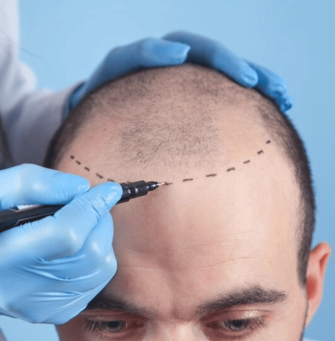 hair transplant center in Kochi & Kozhikode