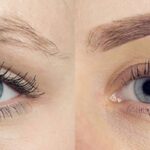 Eyebrow Transplant in Kerala