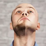 Beard Transplant in Kerala