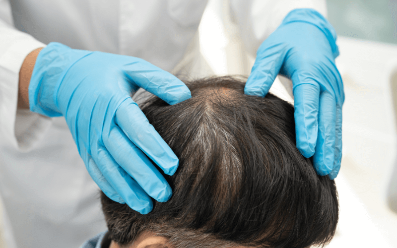 hair transplant in Kerala