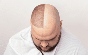 hair transplant in Kerala