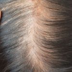 Early Hair Loss Signs