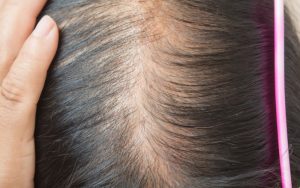 Early Hair Loss Signs