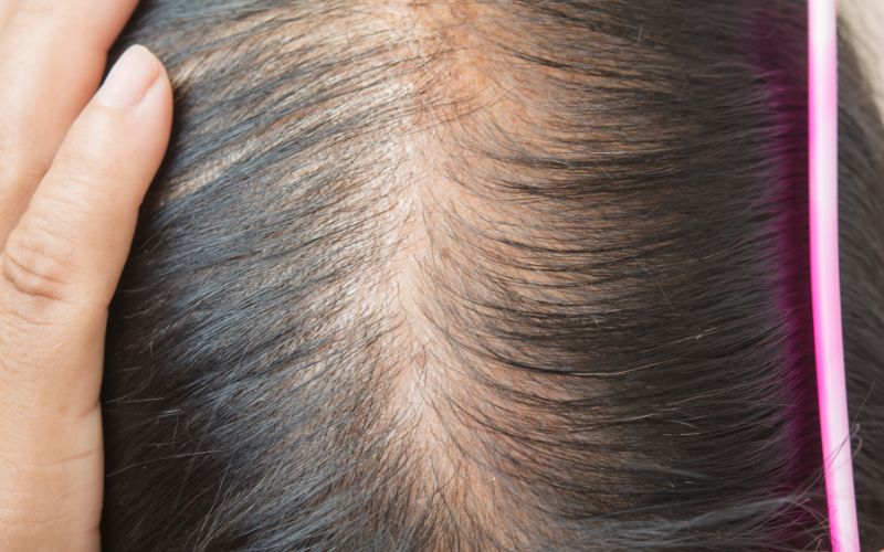 Early Hair Loss Signs