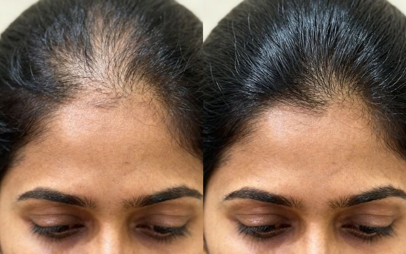 Hair Transplants for Women in India: Benefits, Cost & Results