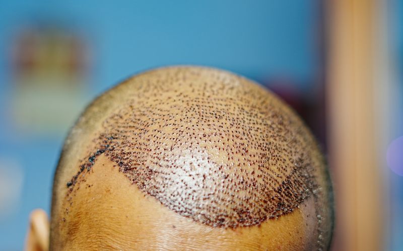 When to Opt for a Hair Transplant