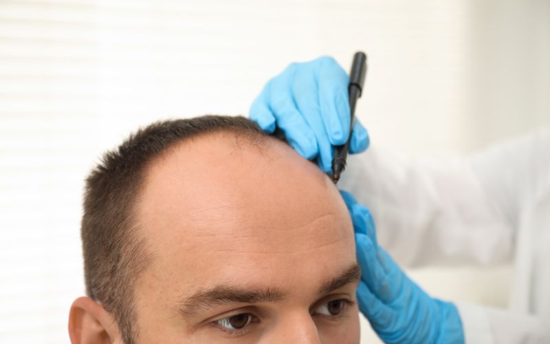 Hair Transplant in Calicut common Questions & Expert Answers img